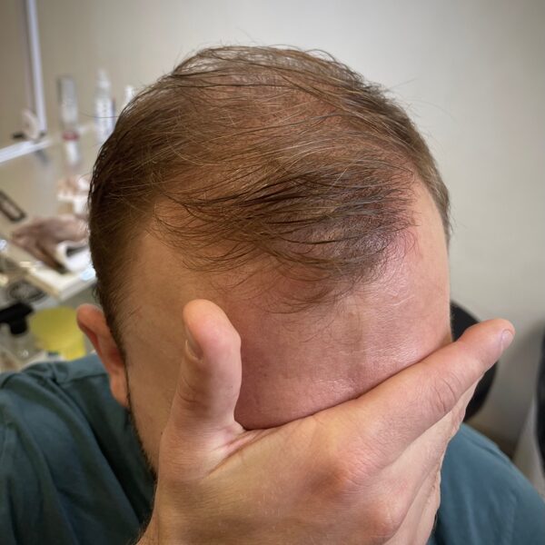 Pēc pamatprocedūras 1x