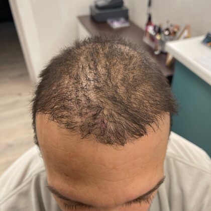 PIRMS PROCEDŪRAS, veikta matu transplantācijas operācija