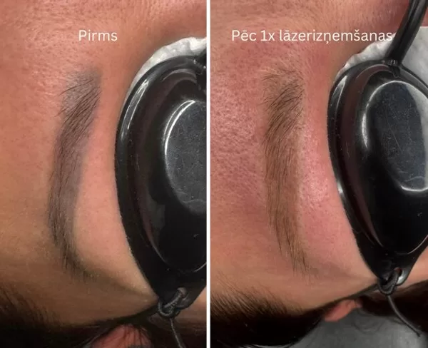 Nevēlama vai vecā permanentā grima noņemšana ar lāzeru