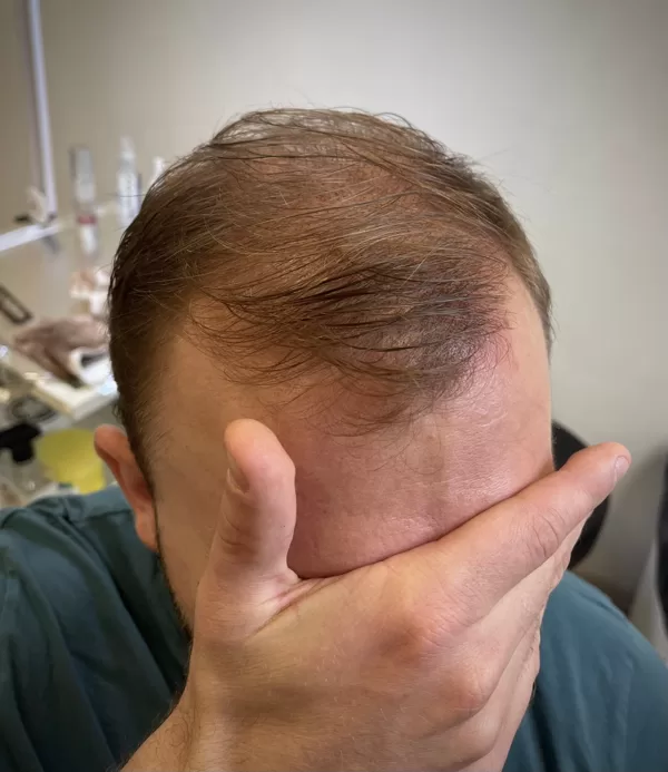 Pēc pamatprocedūras 1x